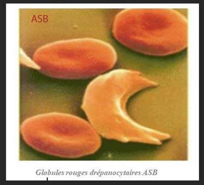 Drepanocytose traitement naturel