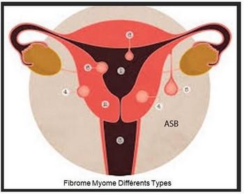 Fibrome differents types de fibrome