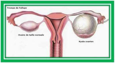 Kyste ovarien Remède Naturel Kyste Ovarien